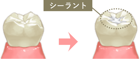 シーラント
